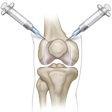 Durolane Injections for Knee Osteoarthritis