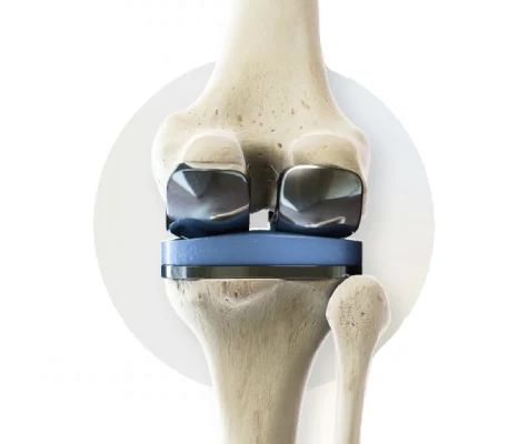 Cost of knee replacement in Borivali